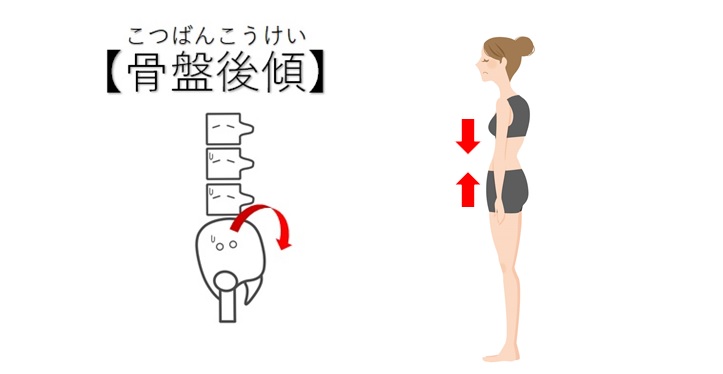 ぽっこりお腹の原因は骨盤前傾 後傾 あなたはどっちタイプ 小顔矯正 整体を東京でお探しならrevision