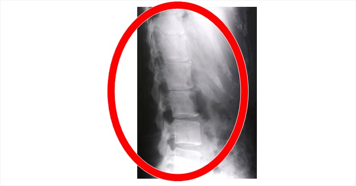 腰椎の前弯が少ないレントゲンの画像