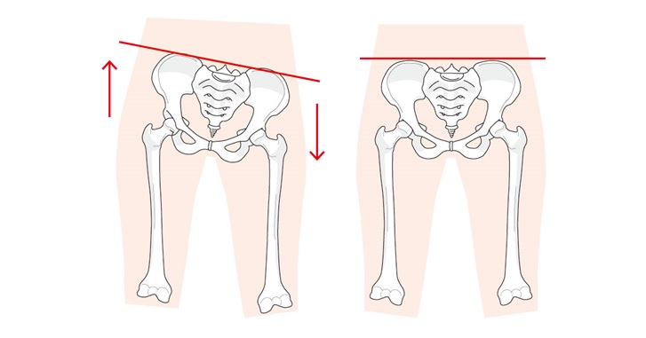骨盤の歪みがあると足の太さが変わる