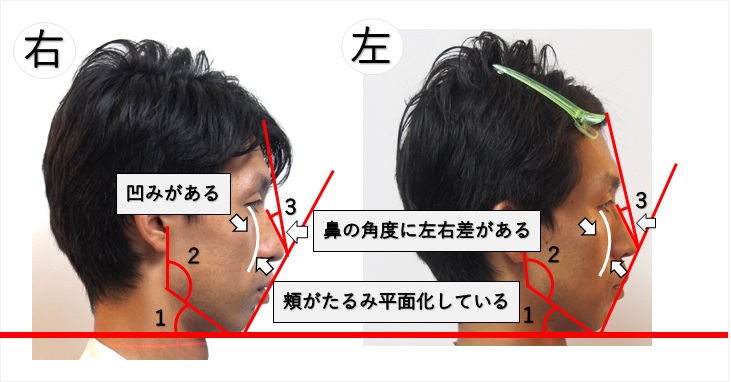 横顔をキレイに見せる鼻と頬骨のバランスのとり方のまとめ 小顔矯正 整体を東京でお探しならrevision
