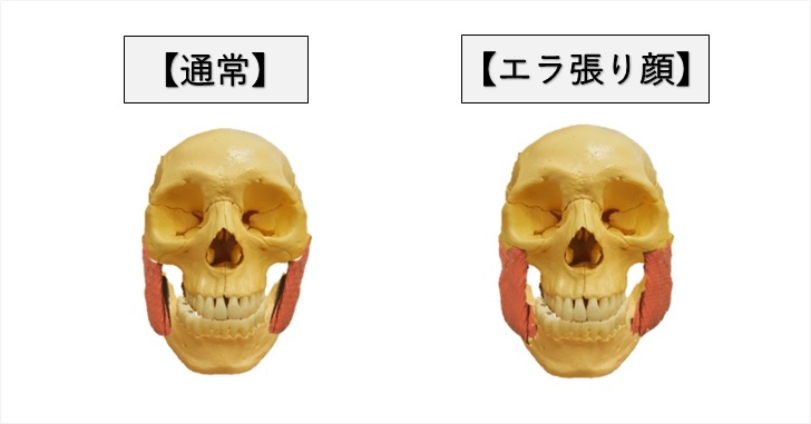 接骨院の院長が教える エラの筋肉をなくす矯正のやり方 小顔矯正 整体を東京でお探しならrevision