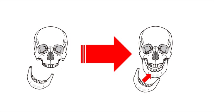 顎引きは顎の位置が改善する