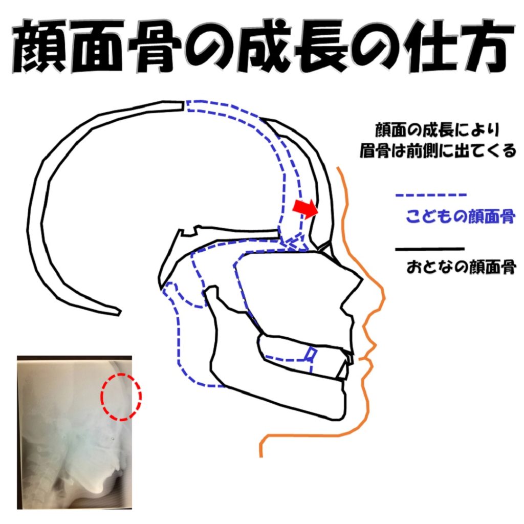 眉骨を中心とした顔面骨の成長の仕方の説明