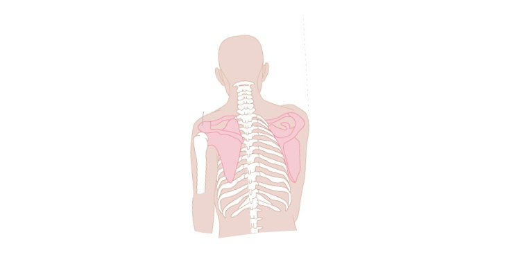 肩甲骨の歪み