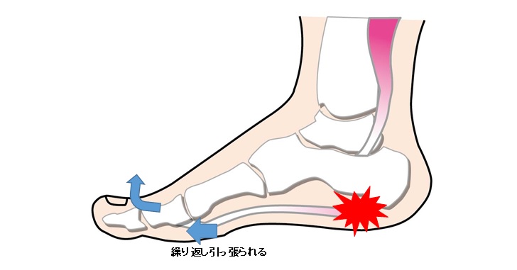 足底筋膜炎の疼痛