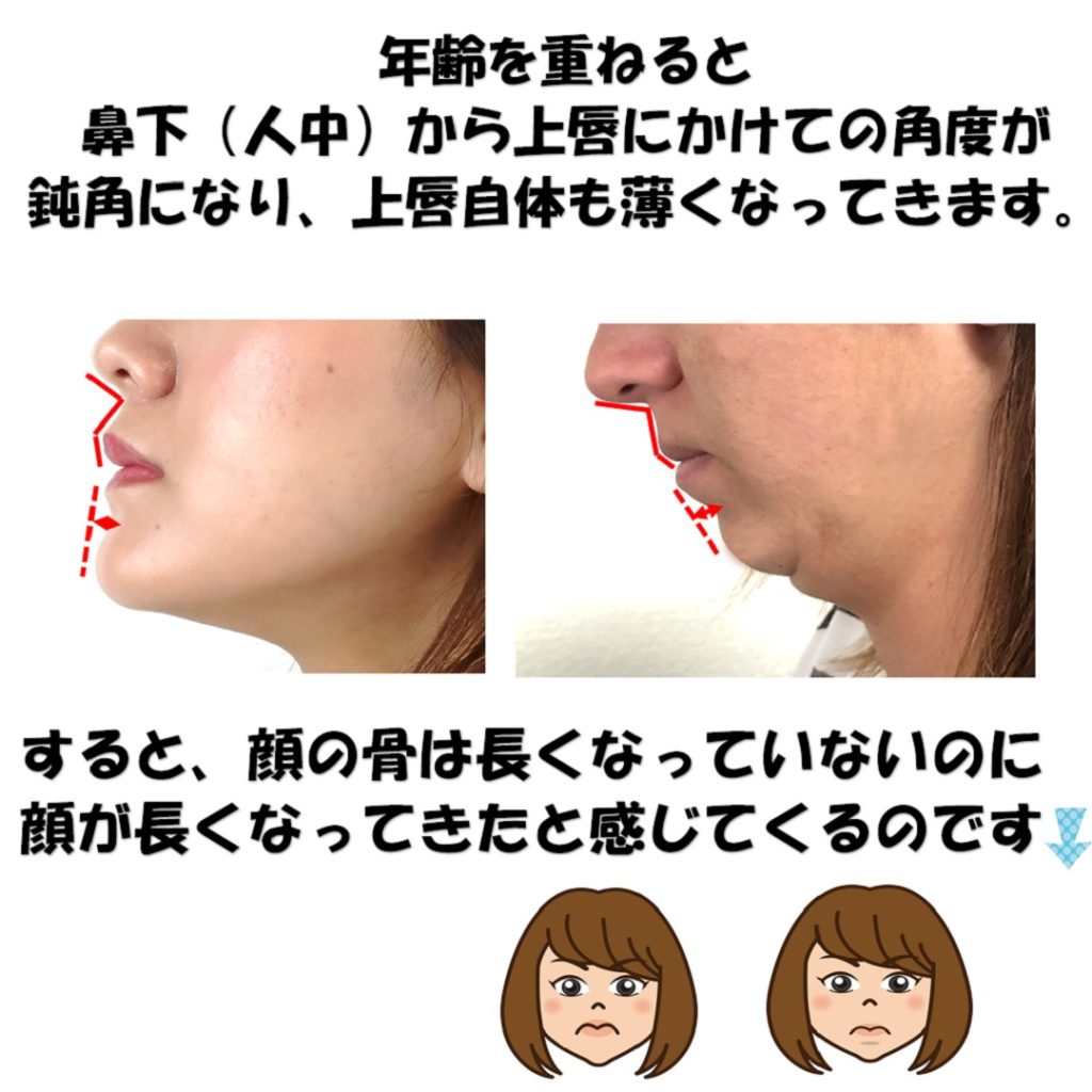 老化による上唇の角度の厚さの減少の説明